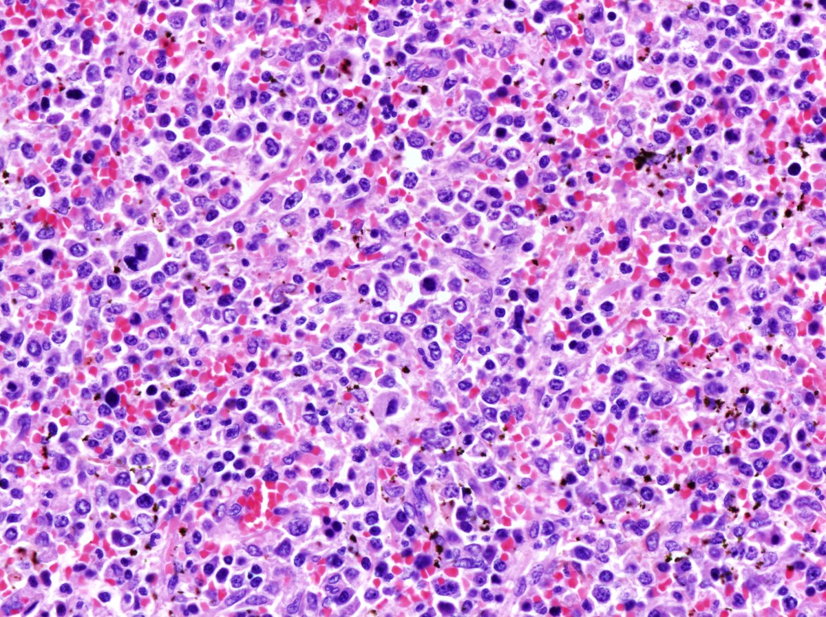 Spleen, splenectomy (1998, submitted): High power image showed cells with blastic morphology displaying high nucleo-cytoplasmic ratio. Numerous dwarf/hypolobated megakaryocytes morphologically similar to the ones in patient’s bone marrow were also identified. 